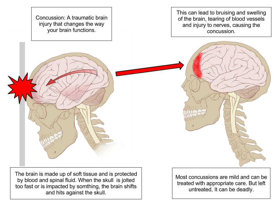 Concussion_Anatomy.png